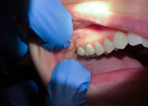 Best Emergency Dentist for Lost Fillings or Crowns in Sheridan, OR