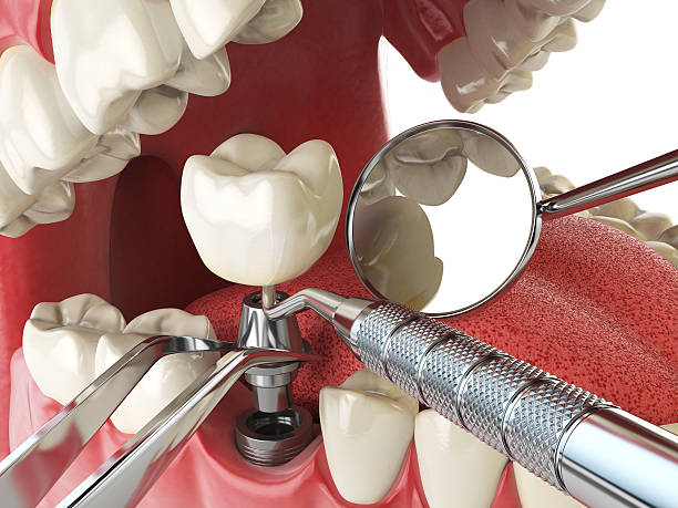 Best Emergency Dentist for Lost Fillings or Crowns in Sheridan, OR
